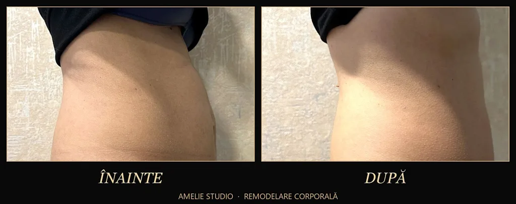 Abdomenul din profil înainte și după o ședință de remodelare corporală la Amelie Studio