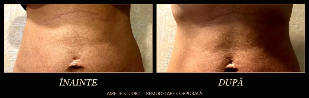 Talia înainte și după o ședință de remodelare corporală la Amelie Studio